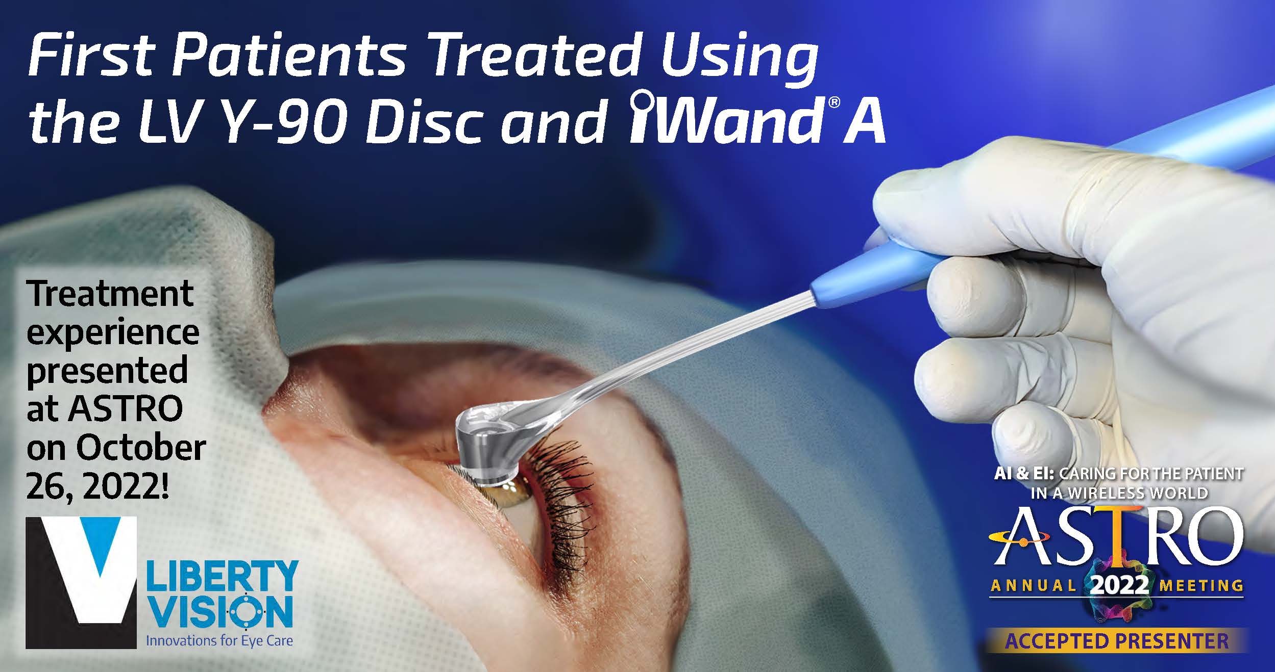 First patients treated using the LV Y-90 Disc and iWand A