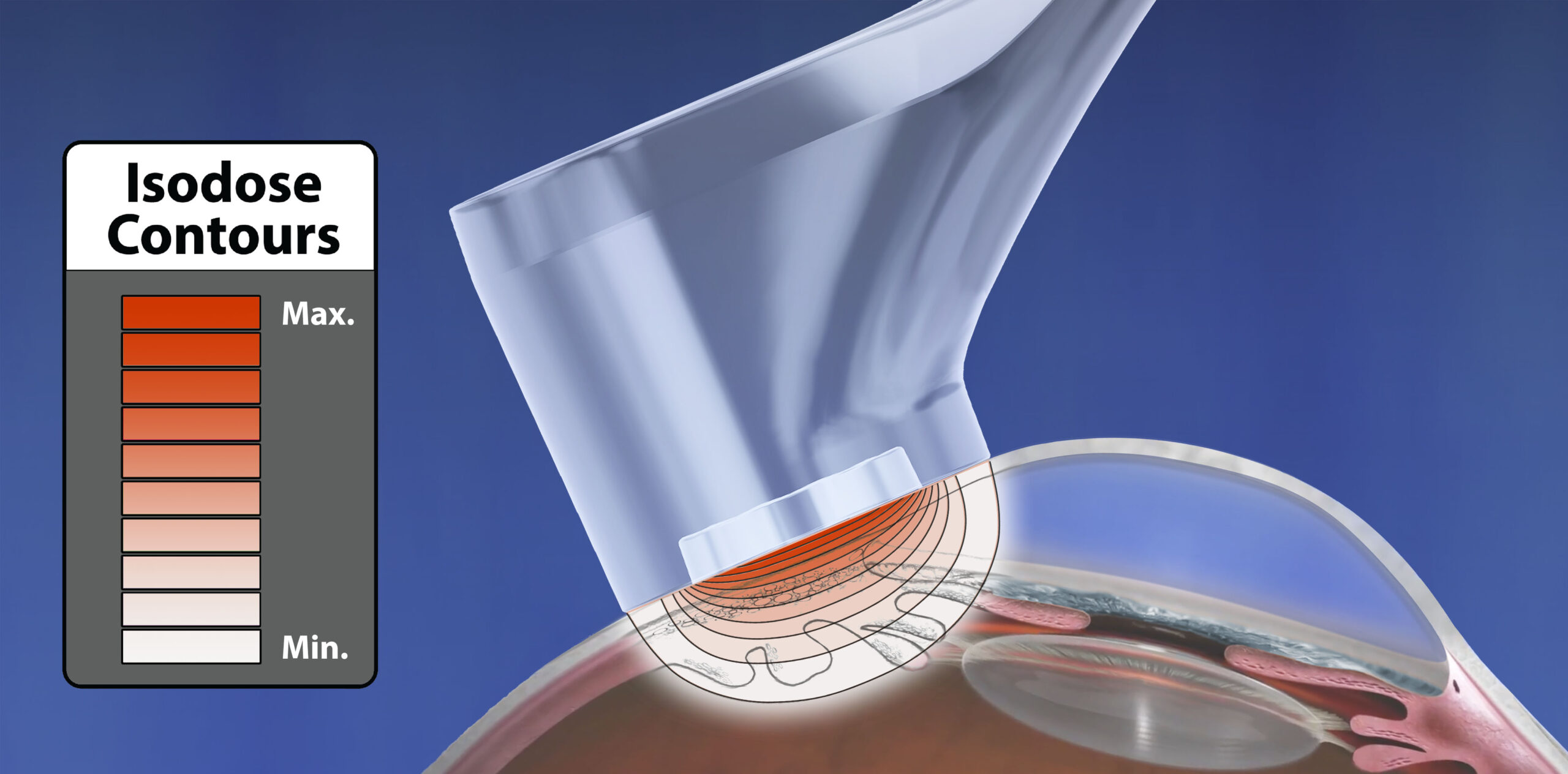 iWand A anterior isodose diagram