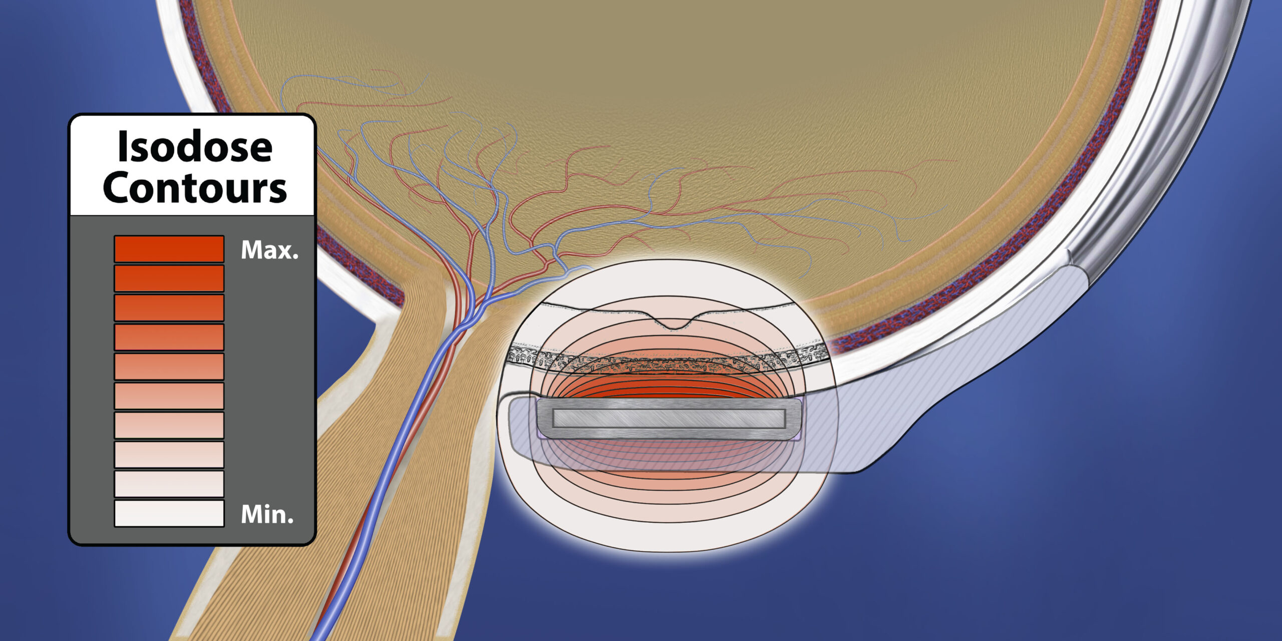 iWand P posterior isodose diagram