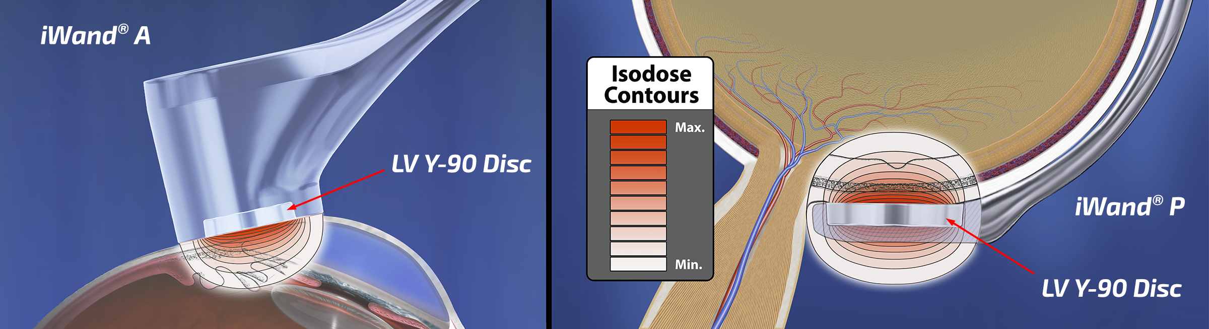 Y-90 isodose penetration diagram showing radiation treatment beyond eye cancer